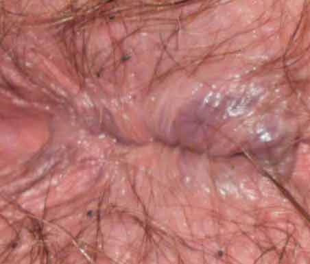 hemorrhoids near anus