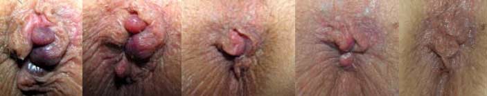 http://www.hemorrhoidshemroids.com/venapro-hemroids-combined-photos-spanning-10-months.jpg  