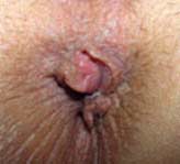 This picture of piles shows the effect of Venapro after using for two months